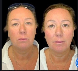 Discover Natural Rejuvenation with Non-Surgical Facelift Treatment in Dubai